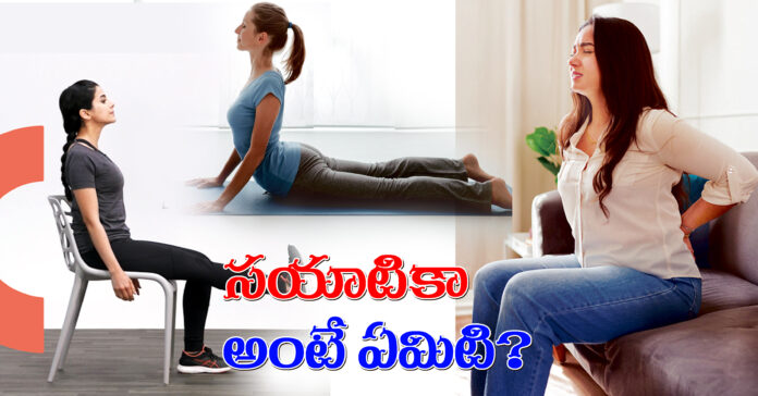 సయాటికా అంటే ఏమిటి?