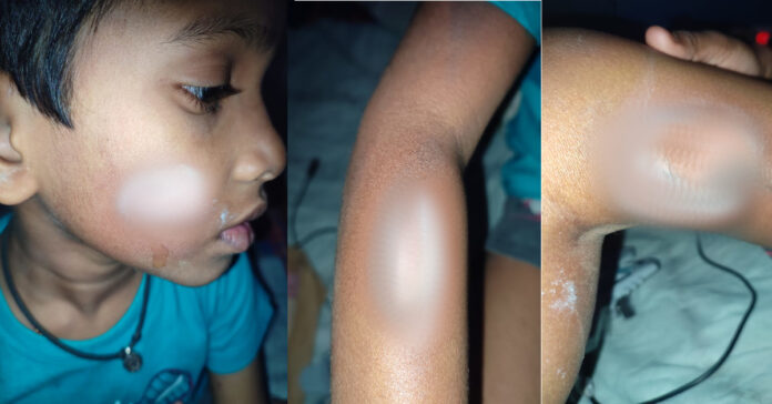 బాలుడి శరీరంపై వేడి అట్లకాడతో వాతలు పెట్టిన ట్యూషన్ టీచర్