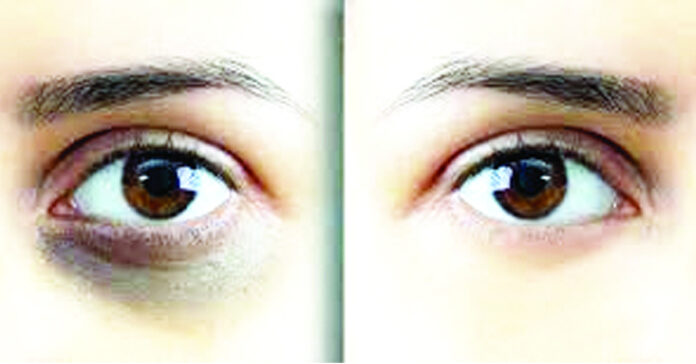 కళ్ళ కింద నల్లమచ్చలా..!