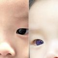 babys-eyes-turn-dark-blue-with-corona-treatment