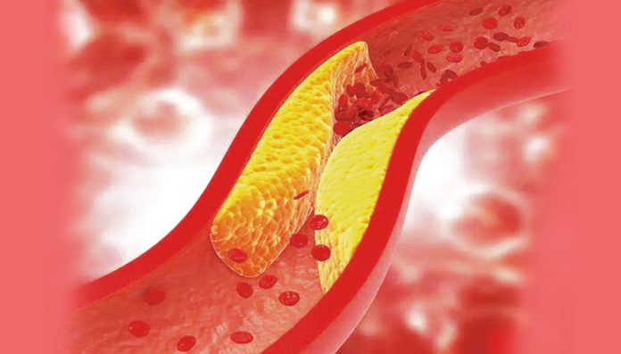If cholesterol is high..