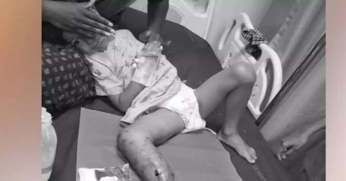 Boy dies of heart attack after leg surgery