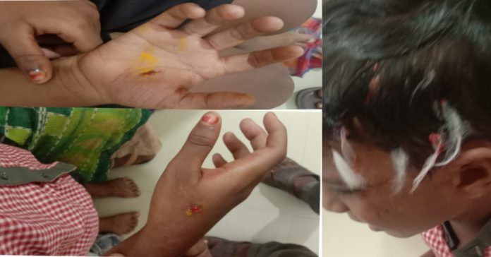 Stray dogs attack boy