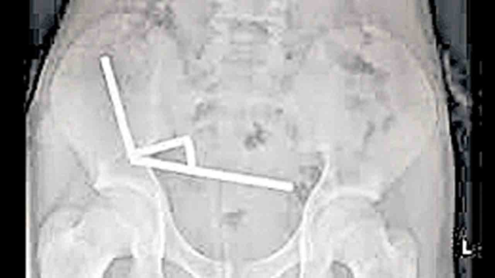 బాలుడి కడుపులో 100 అయస్కాంతాలు