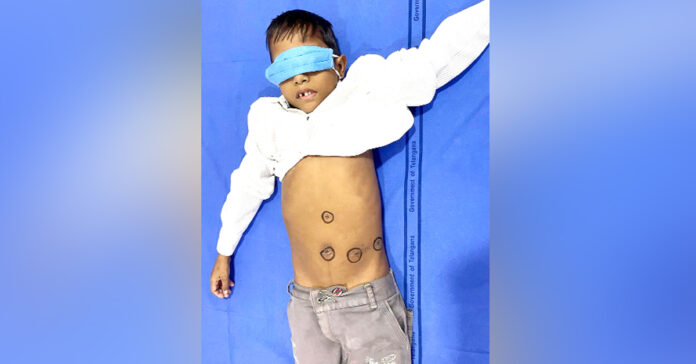 Rare surgery performed on seven-year-old boy in Gandhi