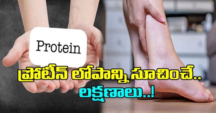 ప్రోటీన్‌ లోపం
