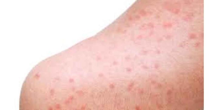 చెమటకాయలు పోవాలంటే…