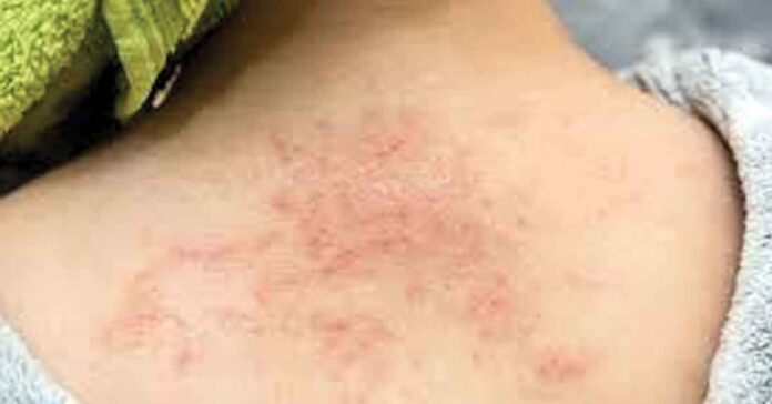 If you want to get rid of sweat glands...