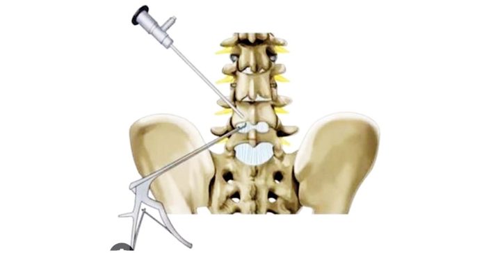 Advanced endoscopic spine surgery at NIMS